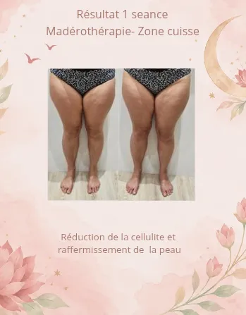 1 ère séance cure madérothérapie cuisse